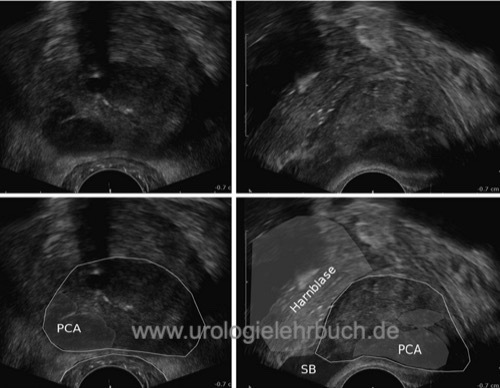 Transrektaler Ultraschall der Prostata (TRUS) www