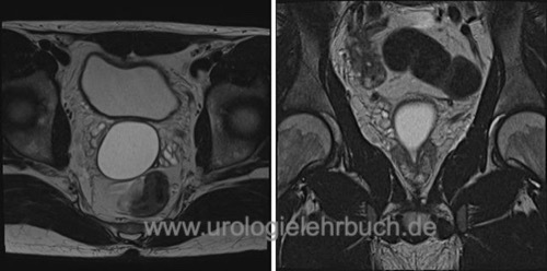 Prostatazyste www.urologielehrbuch.de