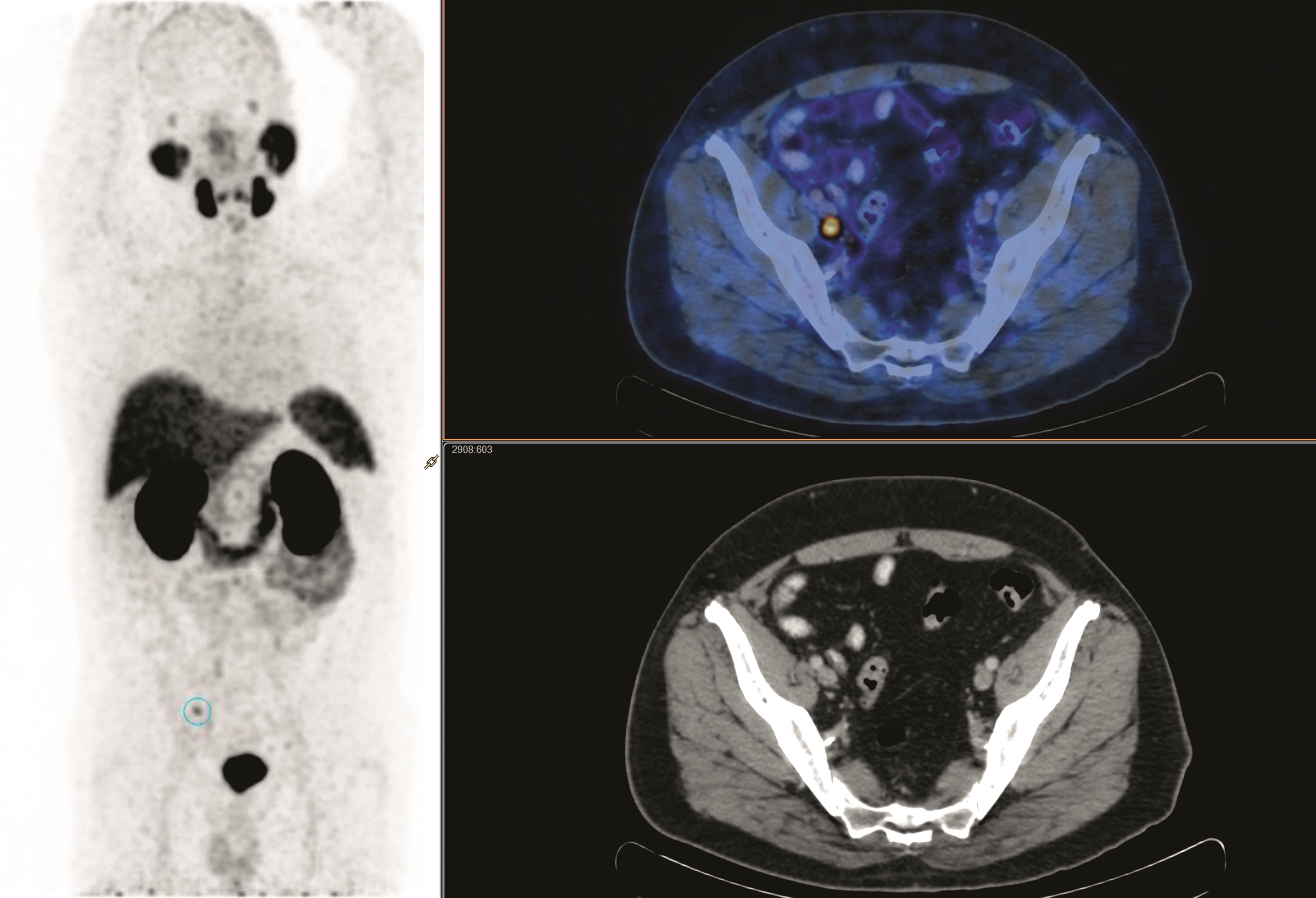 PET Scan Identifies Which Prostate Cancer Patients Can Benefit from