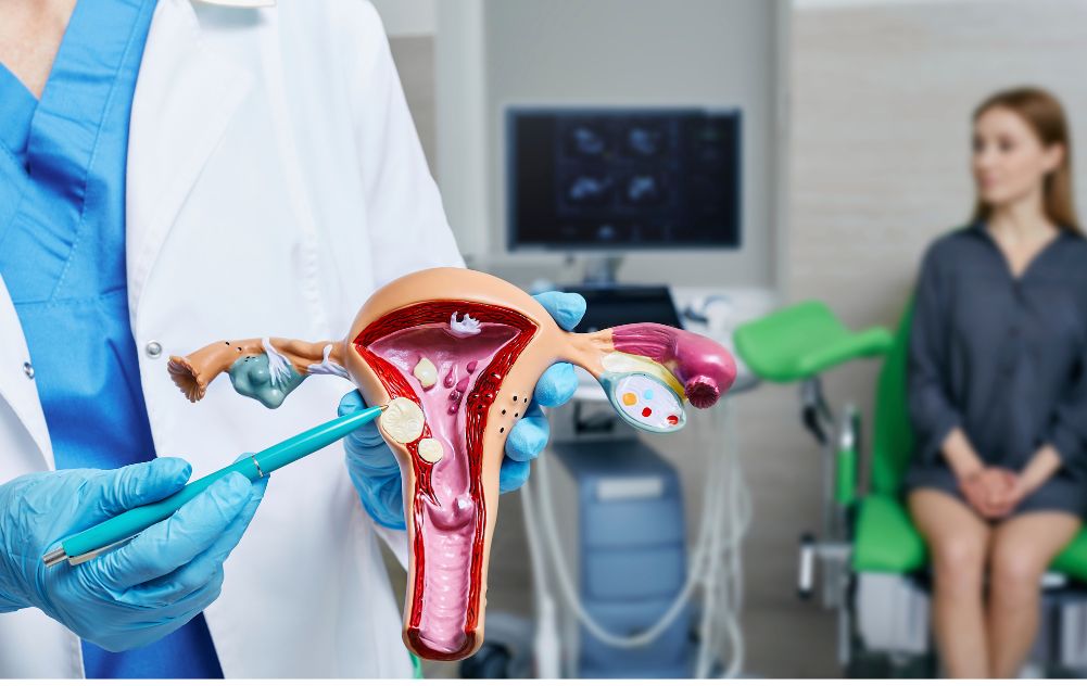 What Is Fibroid Expulsion? What You Need To Know USA Fibroid Centers