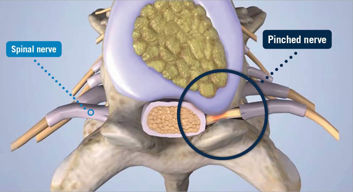Pinched Nerve MRI