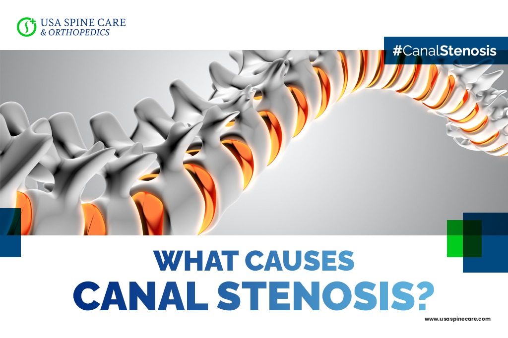 What Causes Canal Stenosis? USA Spine Care Laser Spine Surgery