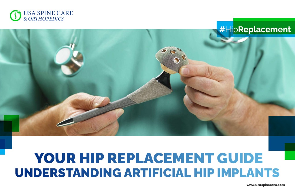 Your Hip Replacement Guide — Understanding Artificial Hip Implants