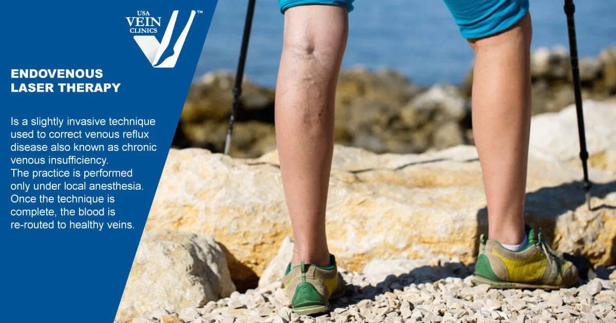 Endovenous Laser Therapy Vs. Sclerotherapy