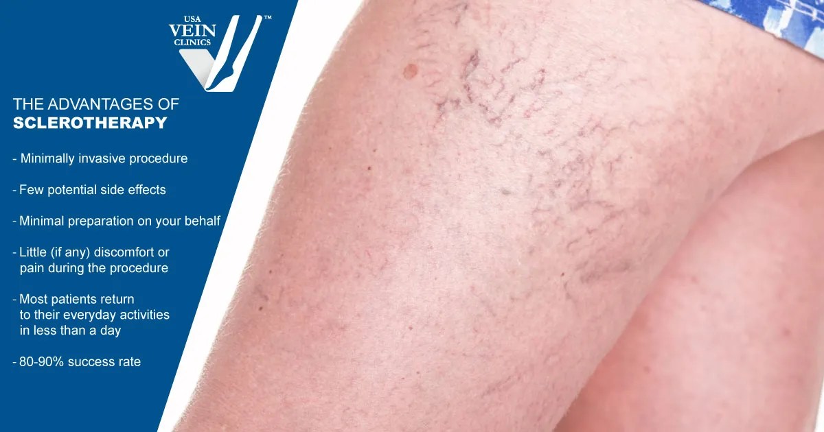 Endovenous Laser Therapy Vs. Sclerotherapy