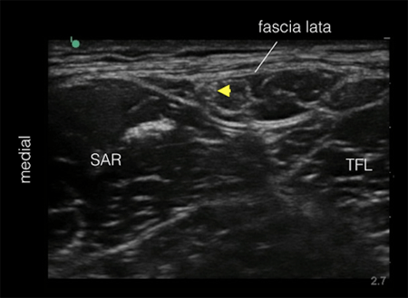 • peripheral nerve field stimulation (pnfs) is the stimulation of unnamed small nerves in the vicinity of pain by superficial, subcutaneous lead placement. USRA - Lateral Femoral Cutaneous Nerve Block