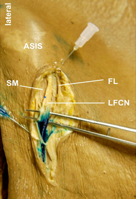 1 meaning of lfcn abbreviation related to nerve USRA - Lateral Femoral Cutaneous Nerve Block