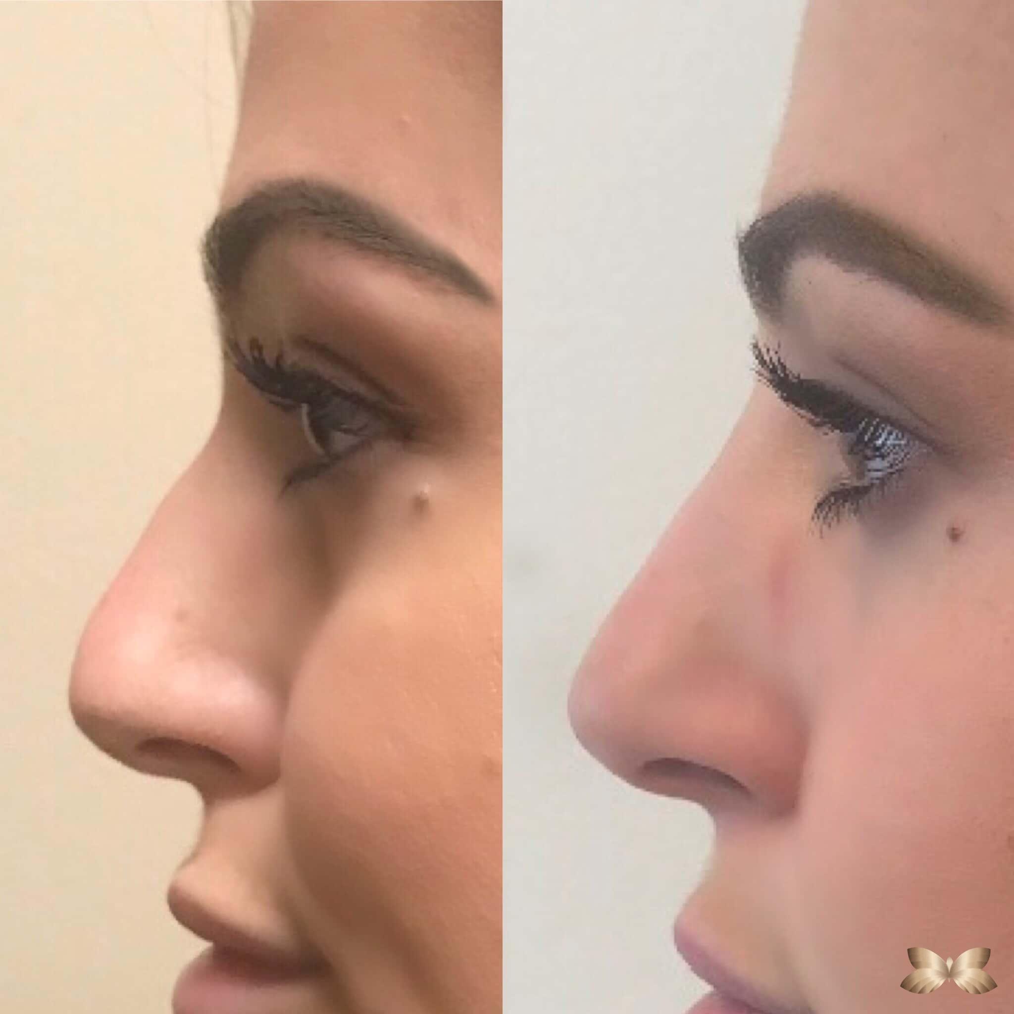 Nonsurgical Nose Job With U92