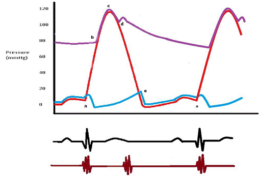 Wiggers Diagram Aortic Regurgitation