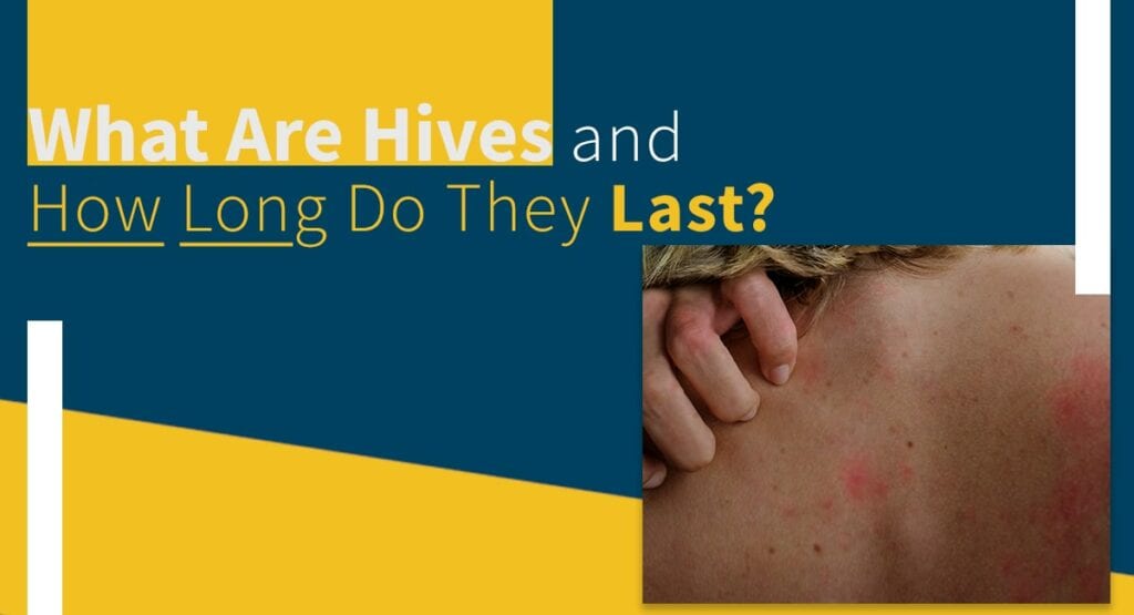 What Are Hives and How Long Do They Last? Valley Skin Institute