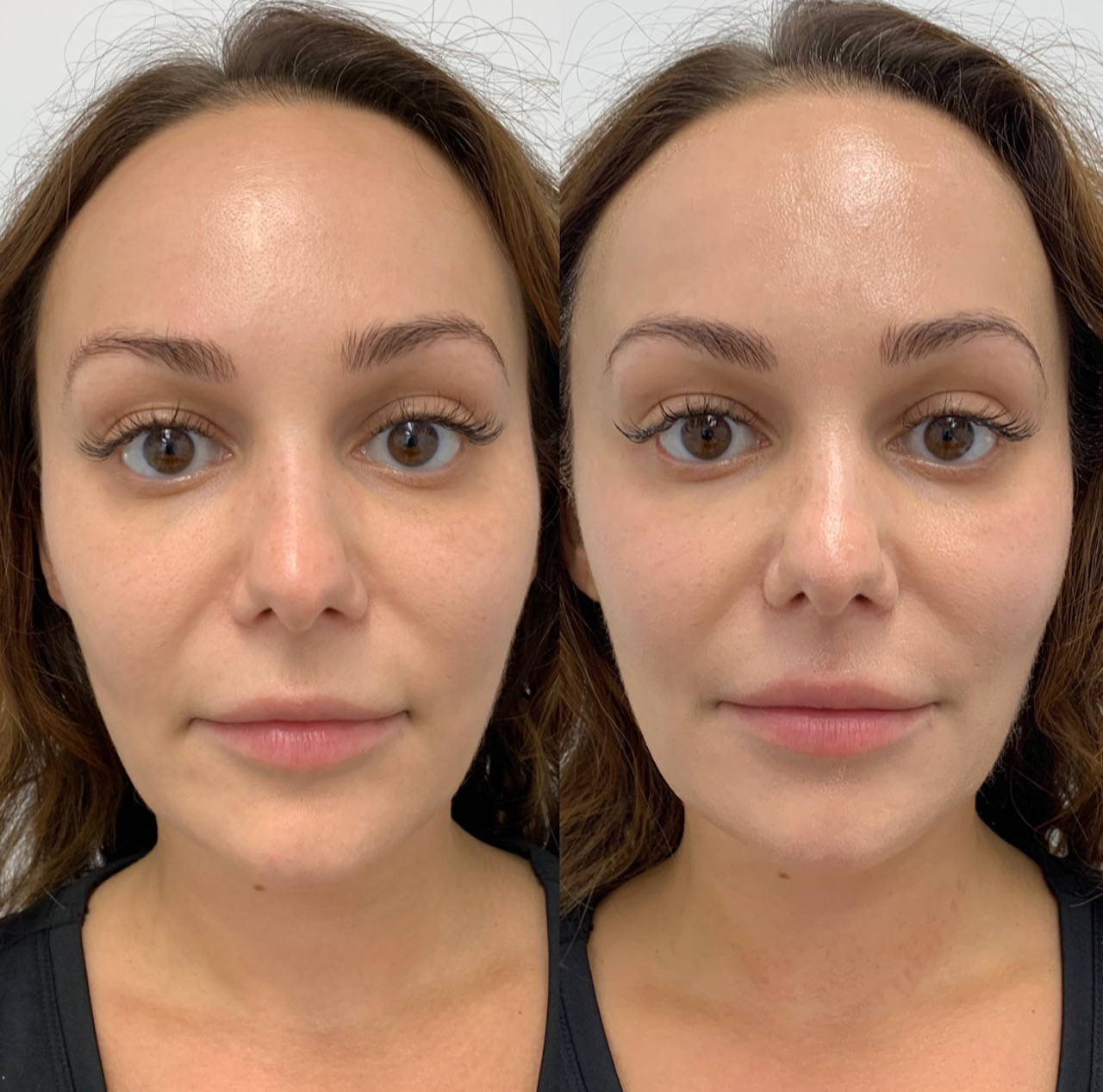 Glass Therapy Vancouver Laser & Skin Care Centre