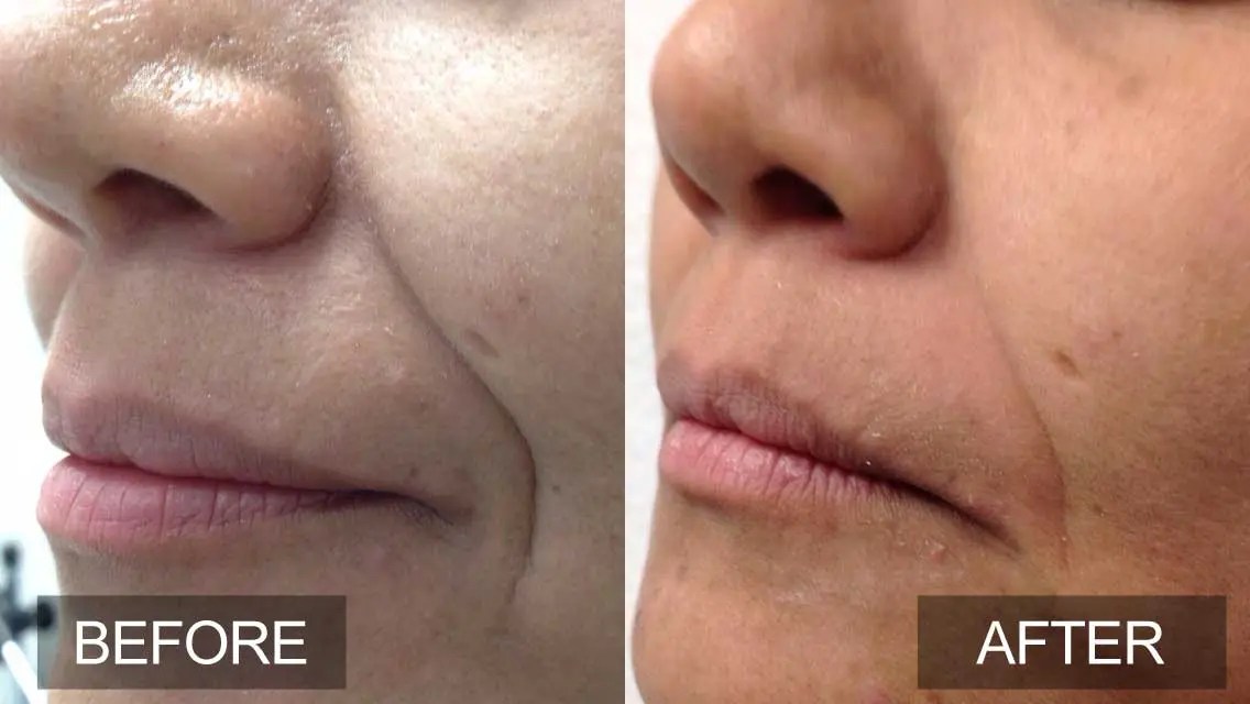 NonInvasive 4D Laser Facelift l Vancouver Medi Spa