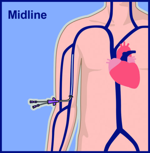 Peripheral IVs and PIVs | Vascular Wellness