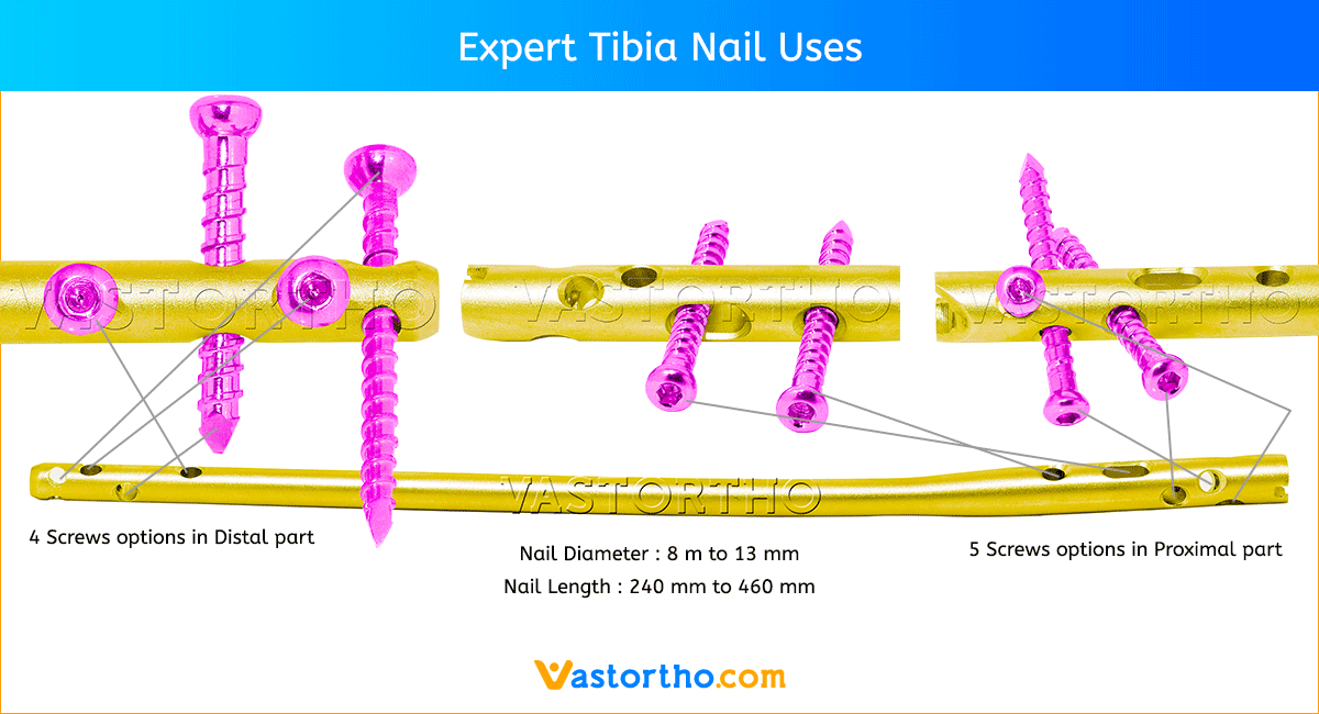 Expert Tibia Nail Uses, Sizes & Surgical Techniques • Vast Ortho