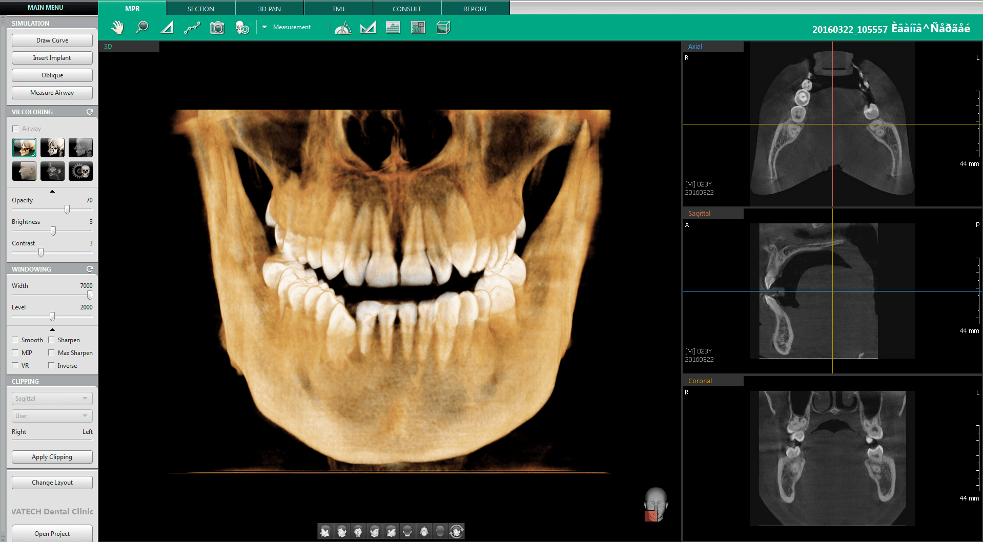 Ez3Di 3D Software VATECH