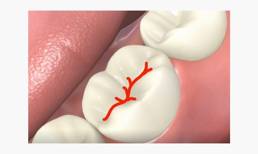 Fissure Sealants VC Dental