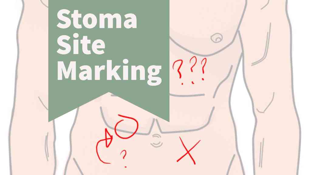 The Importance of Stoma Site Marking (w/ video) VeganOstomy