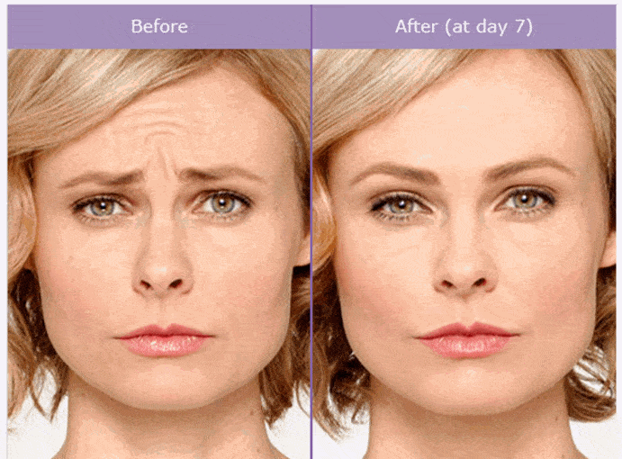 Botox Before and After Pictures Jersey City, Newark, NJ