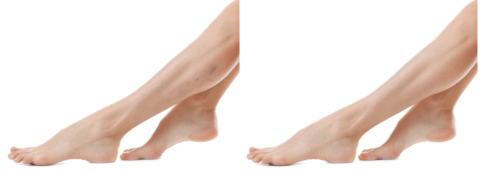 When Can I Say Goodbye to My Problem Veins? Vein Clinic Kansas City
