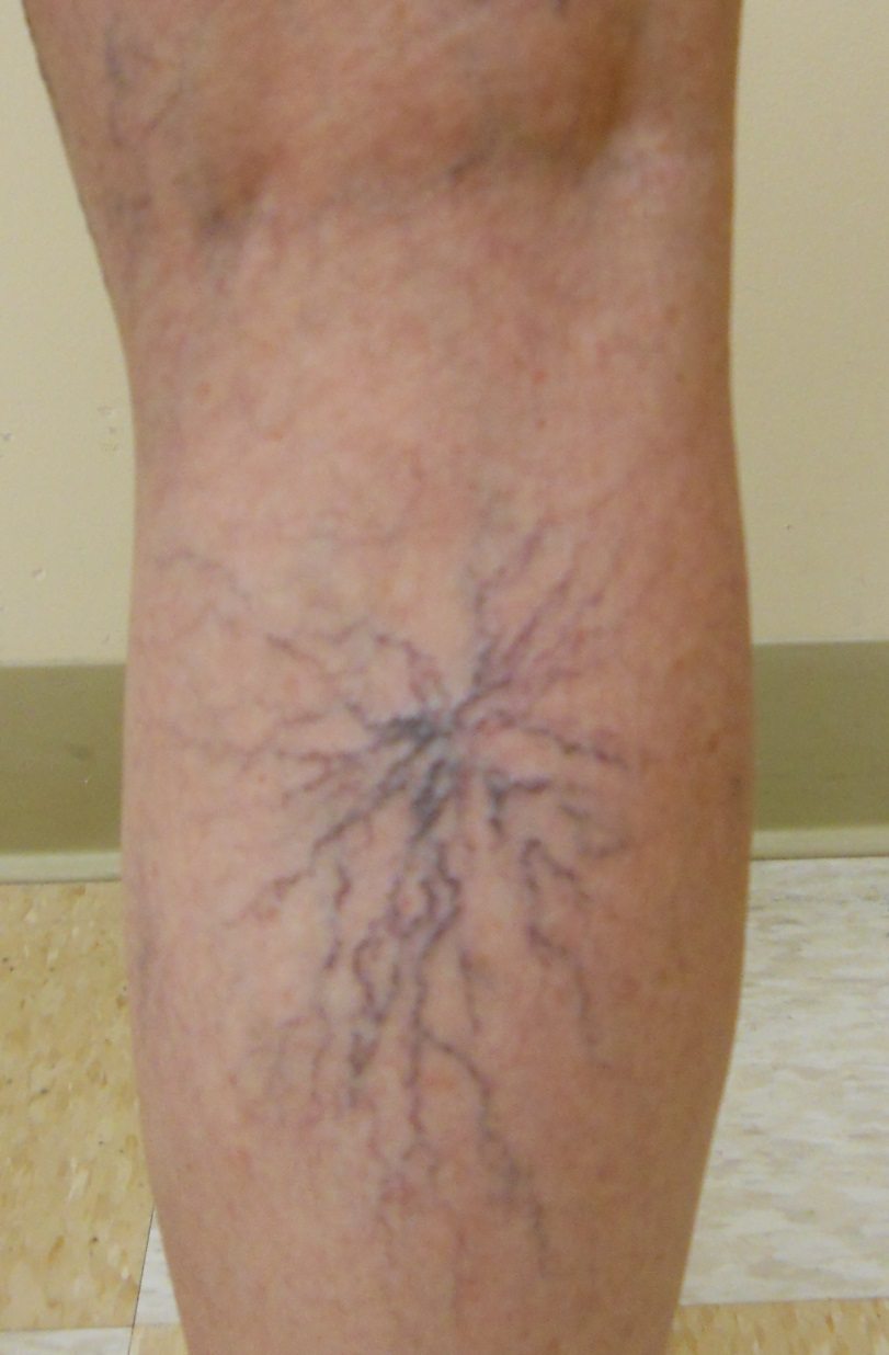 Spider Veins Charlotte Spider Vein Treatment