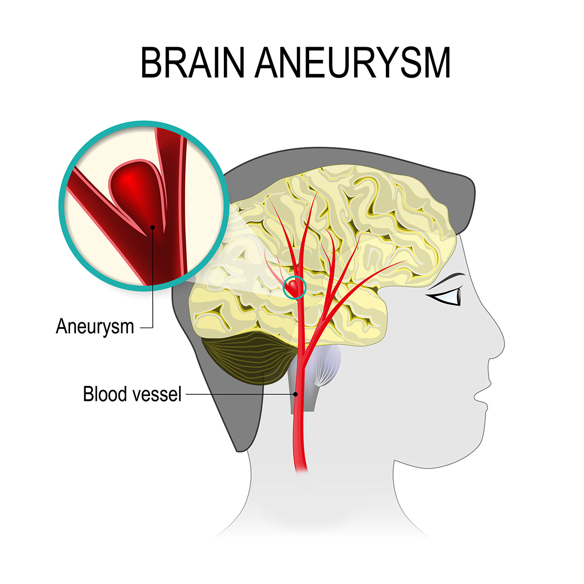 Brain Aneurysm Treatment Vejthani Hospital