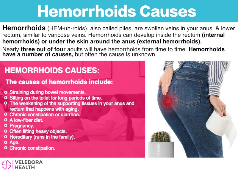 Hemorrhoids, Causes, Symptoms And Treatment!