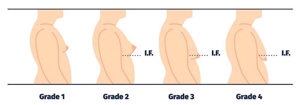 The #recurrence of breast enlargement is uncommon following #gynecomastia surgery.however, it can occur due to steroid use. Web web unfortunately, steroid use can trigger hormone imbalances and, subsequently,. Surgery Cost In Bangalore, India Best