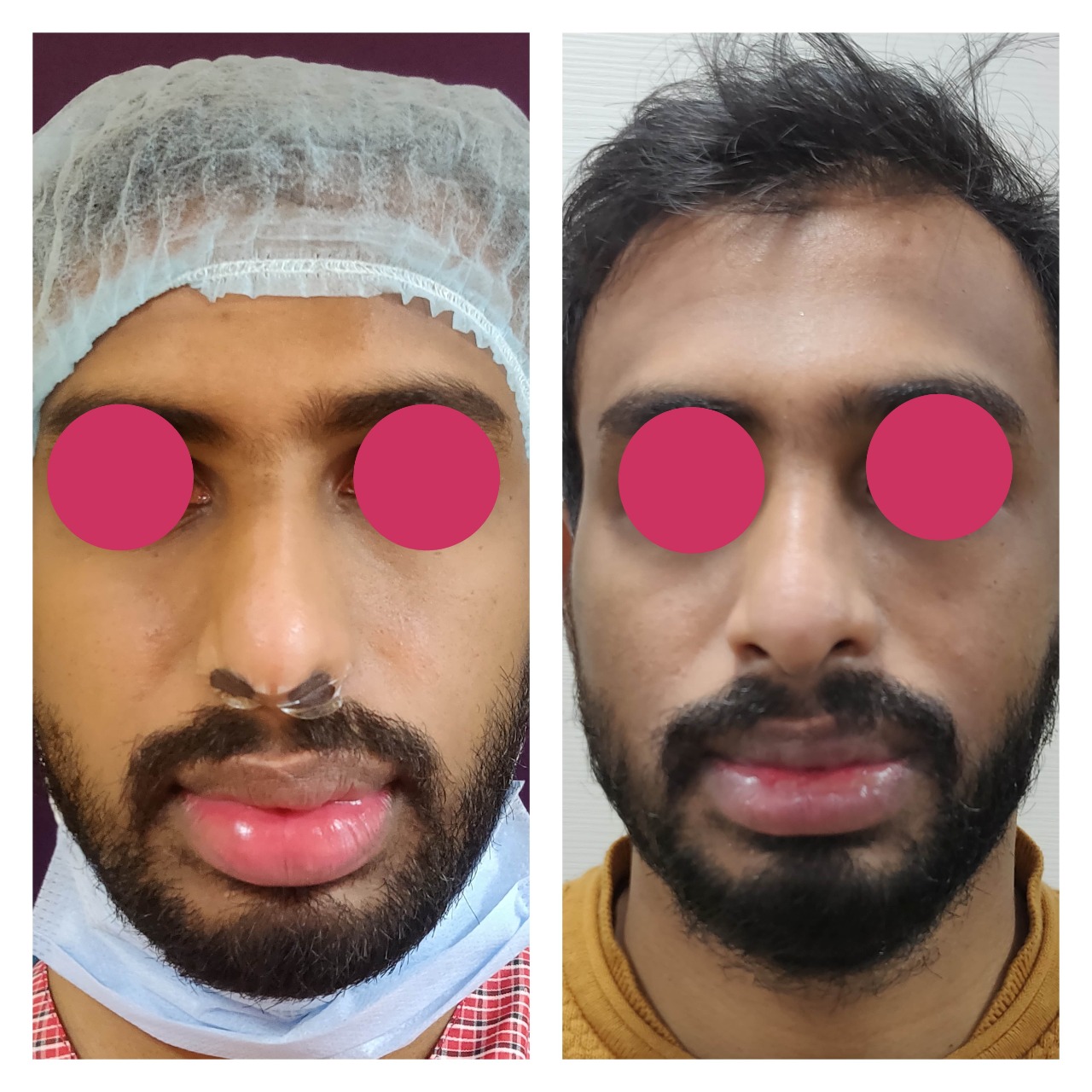 How To Reduce Lips Without Surgery In India