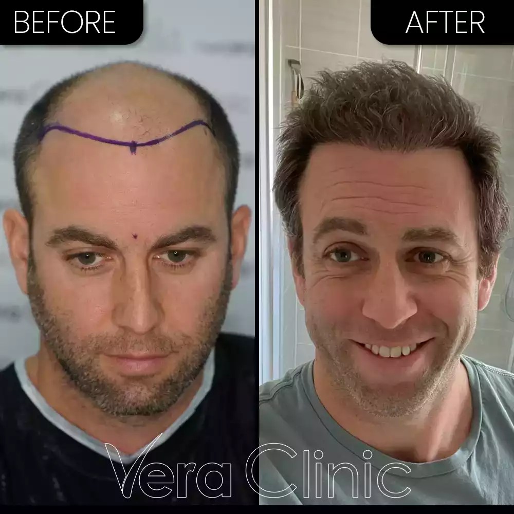 Hair Transplant Turkey/Istanbul