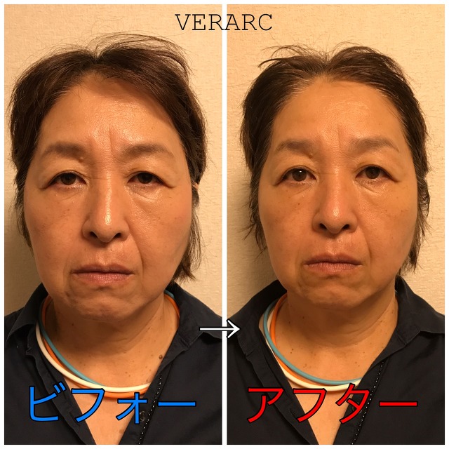 たるみ解消に効く！下げて上げるマッサージ | ハルメク美と健康 たるみ改善、リフトアップで目もぱっちり（50代） - 浜松市の小顔矯正で整形級に【エラ】をなくせるのはヴェルアークだけ！(静岡県浜松市東区篠ケ瀬町)