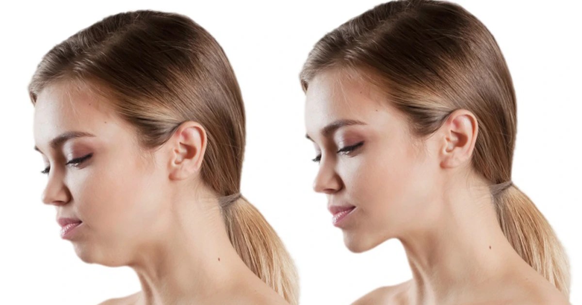 Jaw Surgery Vera Smile