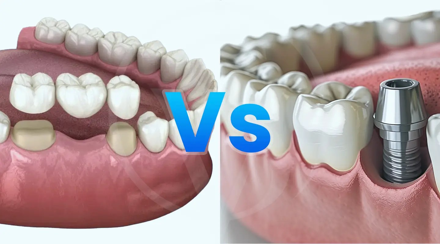 Dental Bridges vs. Dental Implants: What’s the Real Cost of