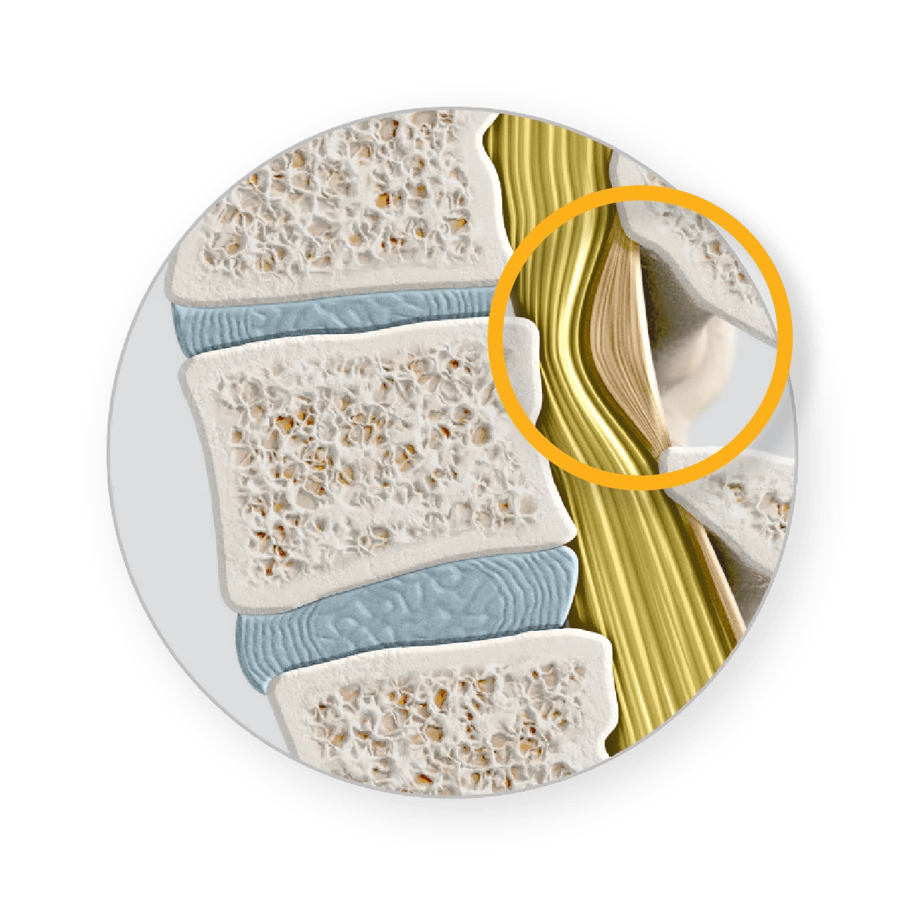 Mild® Procedure for Lumbar Spinal Stenosis (LSS) | Vertos Medical