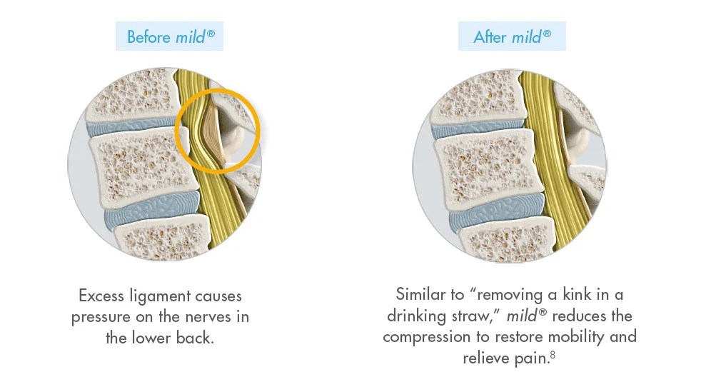 How Do You Describe the mild® Procedure to Your LSS Patients?