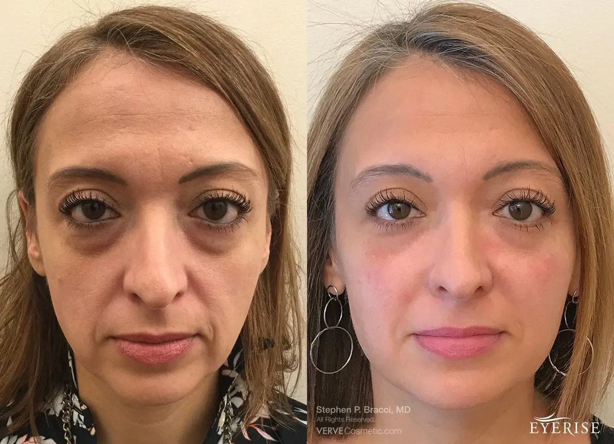 Belotero Before And After Under Eyes