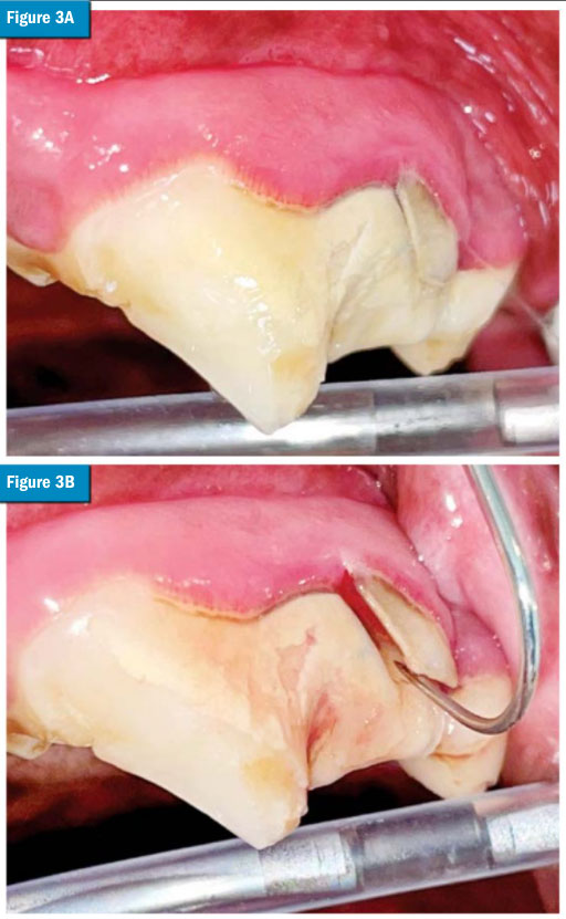 Treatment options for carnassial tooth fractures in dogs Veterinary