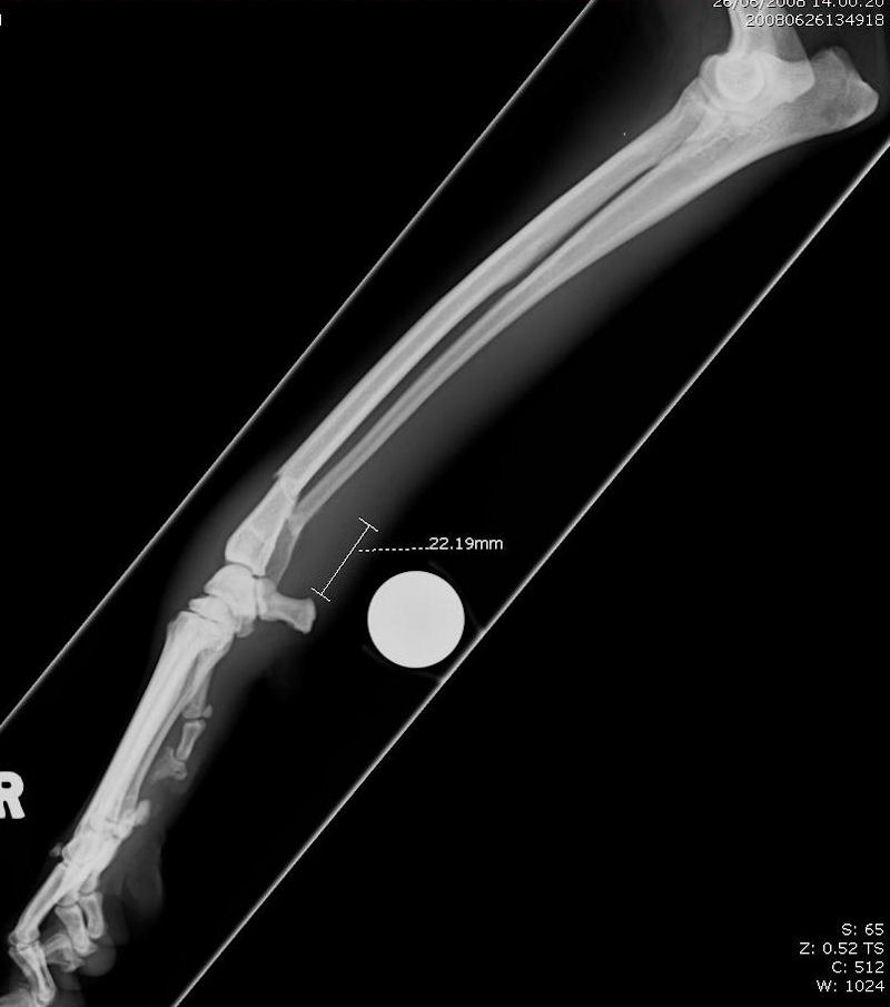 Radius ulna fracture (preoperative) 01 radiograph mediolateral in