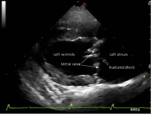 Heart mitral valve thickening and prolapse 01 ultrasound in Dogs