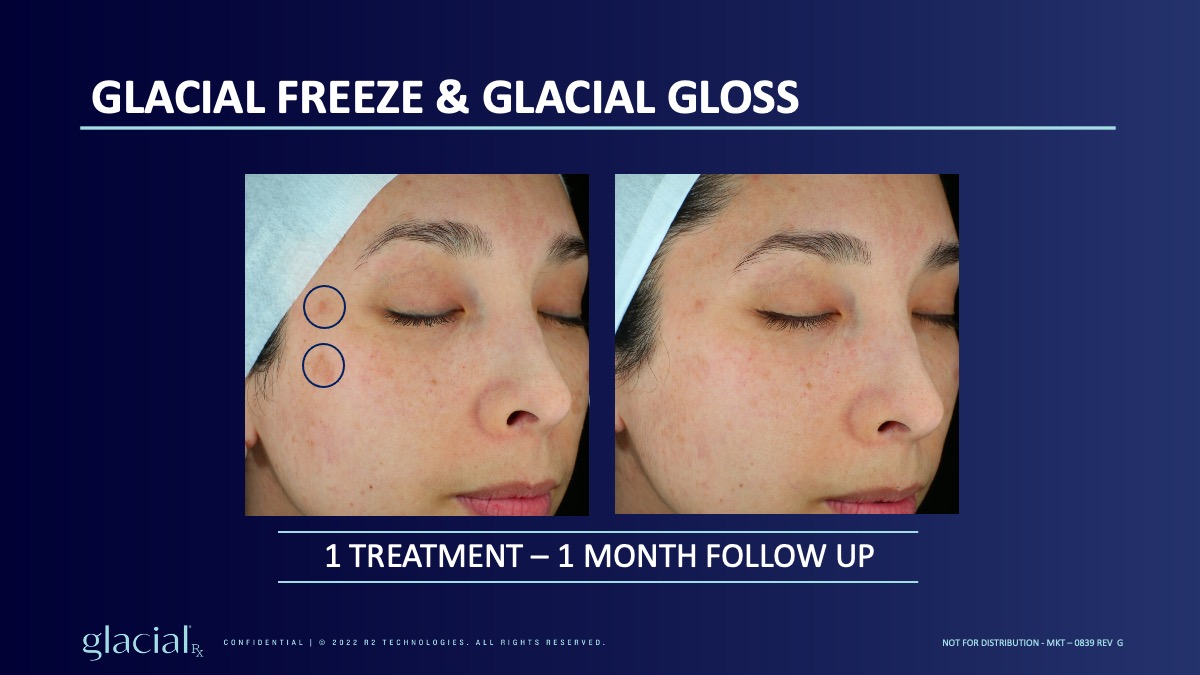 Glacial Rx at Vibrant Med Spa in Round Rock, Texas