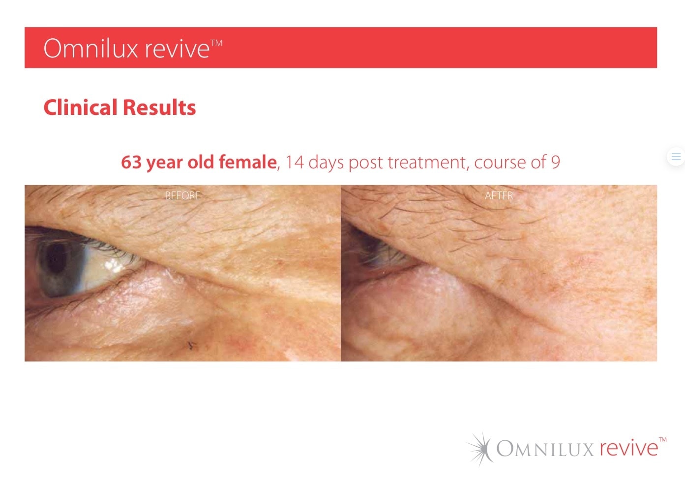 Omnilux Revive Light Therapy