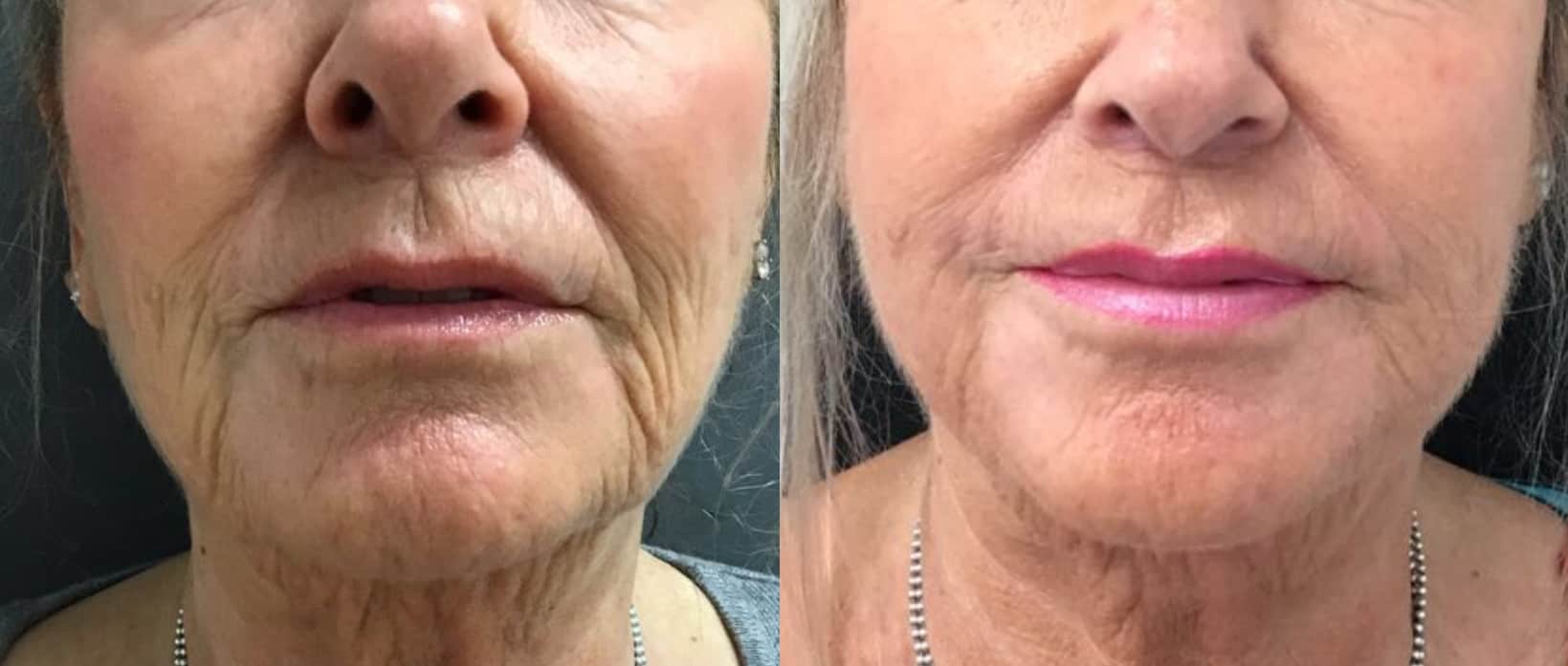 HIFU Before & After Results Vie Aesthetics(04)
