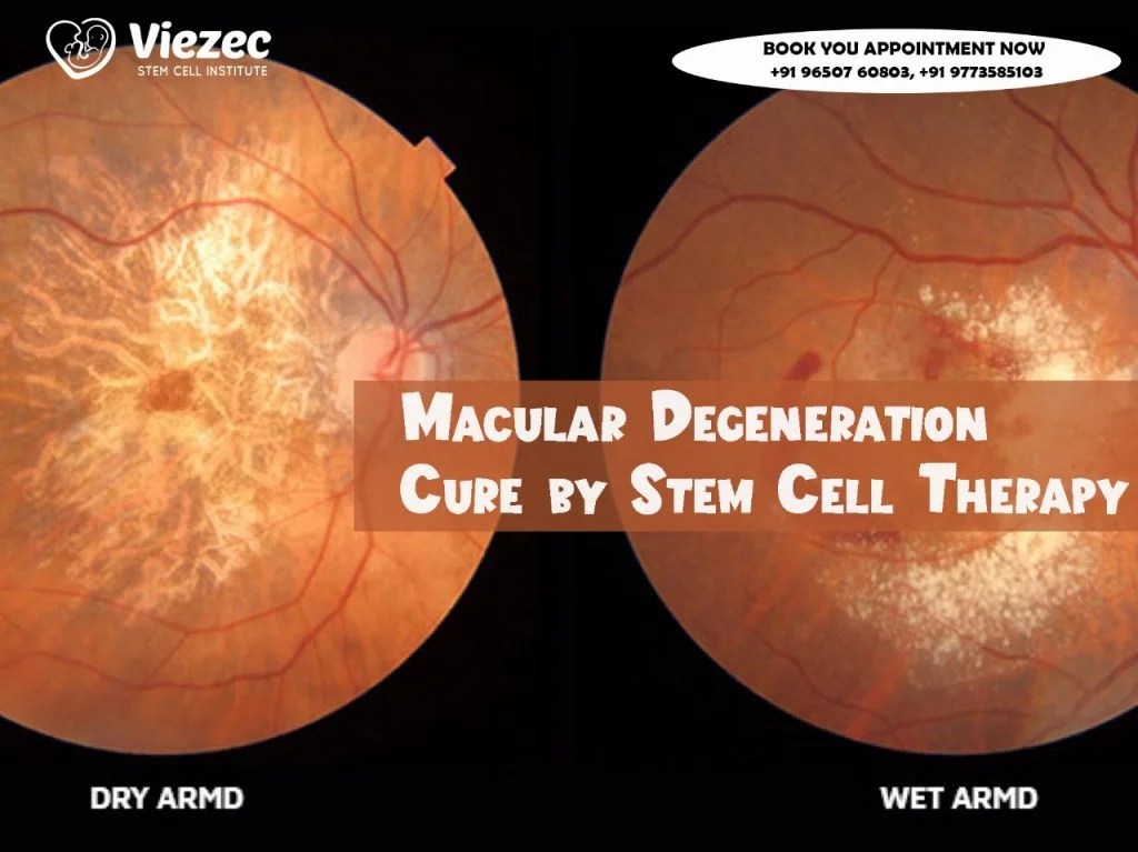 Promise of Stem Cell Therapy for Macular Degeneration