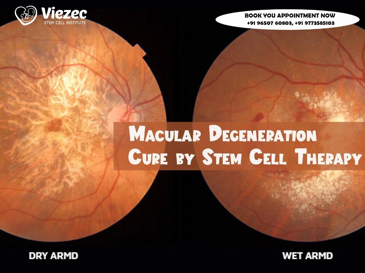 Promise of Stem Cell Therapy for Macular Degeneration