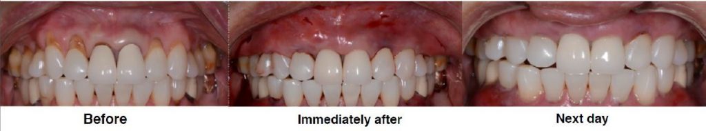 Stop “Watching” Gum Recession! VIPS Dental Blog