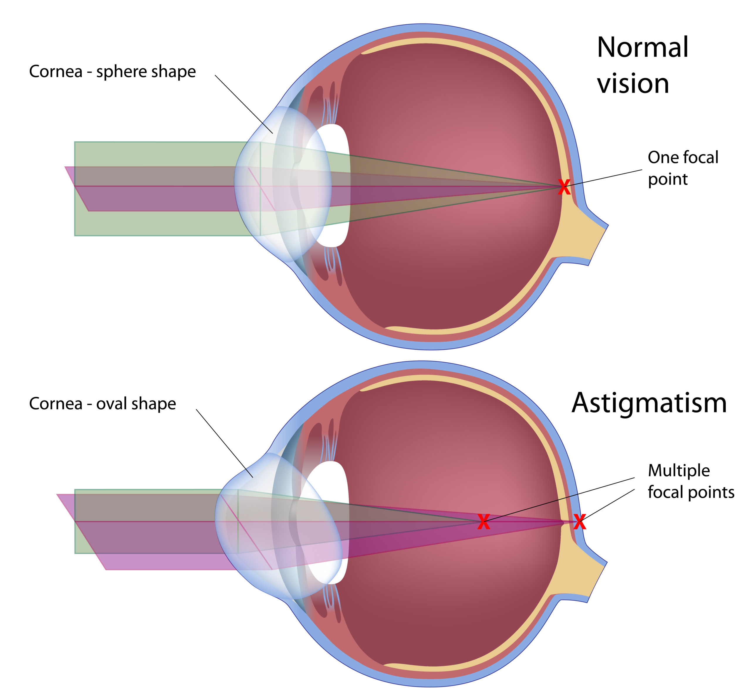 Astigmatism (Causes, Symptoms & Treatment)