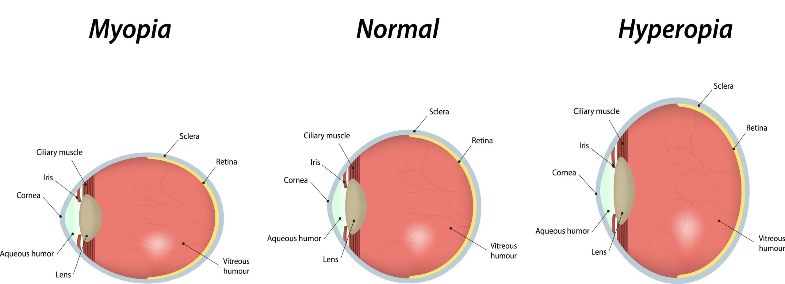 Is a 1.25 Eye Prescription Bad? Do I Need Glasses?