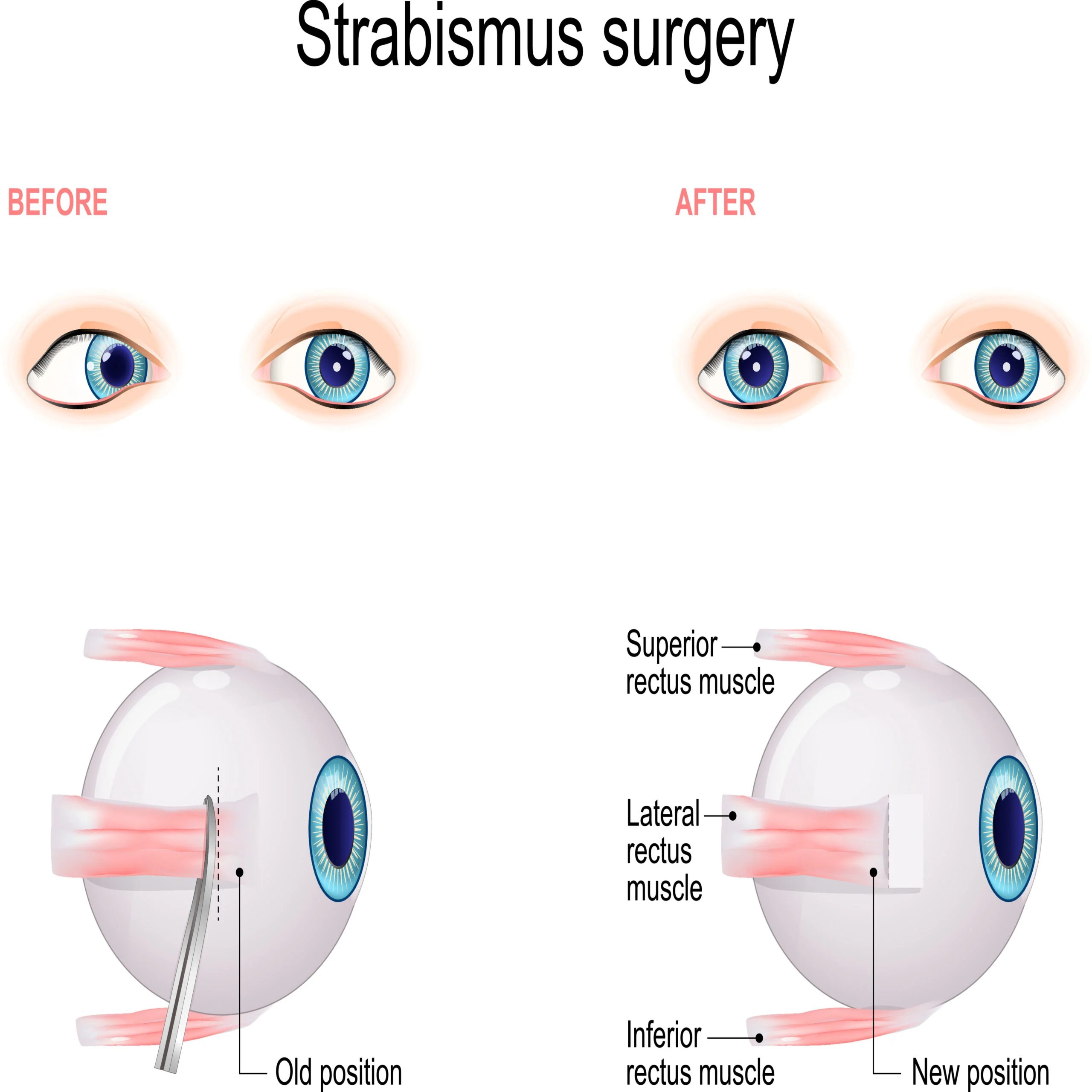 Strabismus Surgery (What to Expect & FAQ) Vision Center