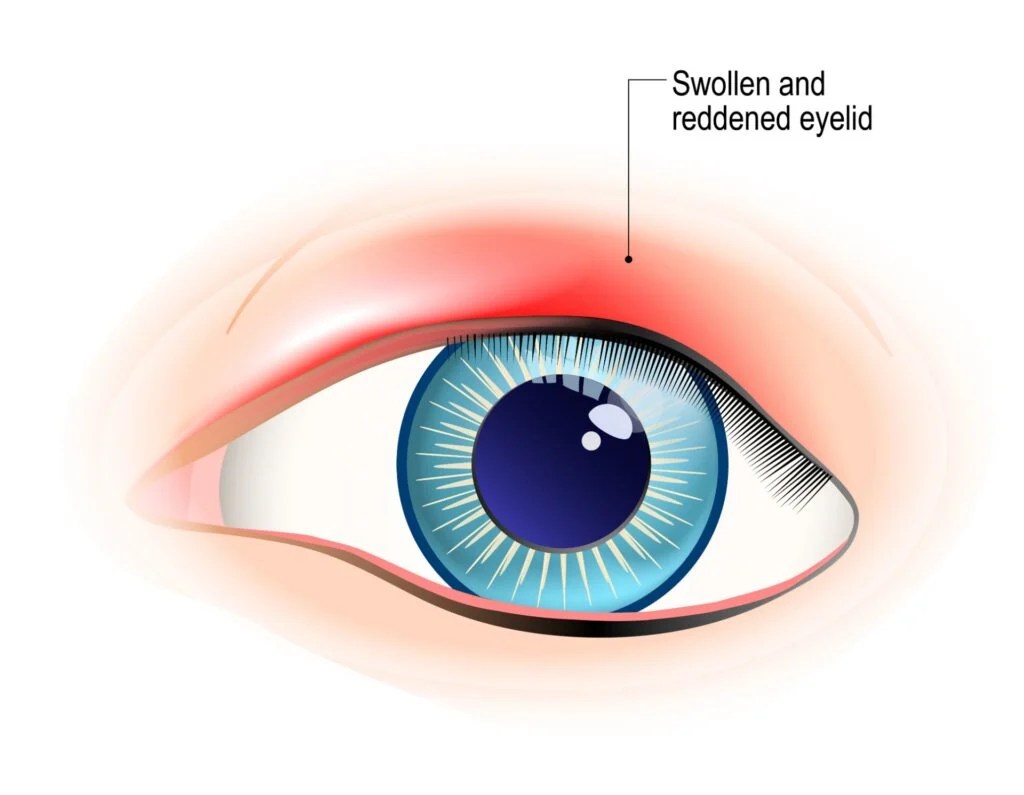 Eye Styes Causes, Symptoms, & Treatment