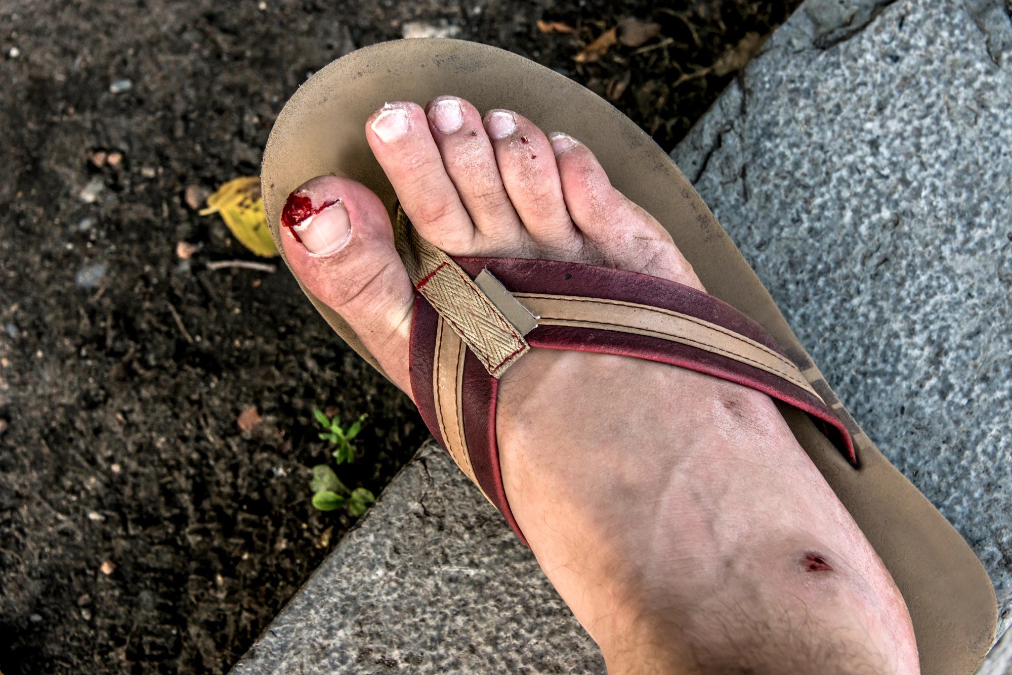 4 Flip-Flop Injuries to Avoid This Summer | Complete Care