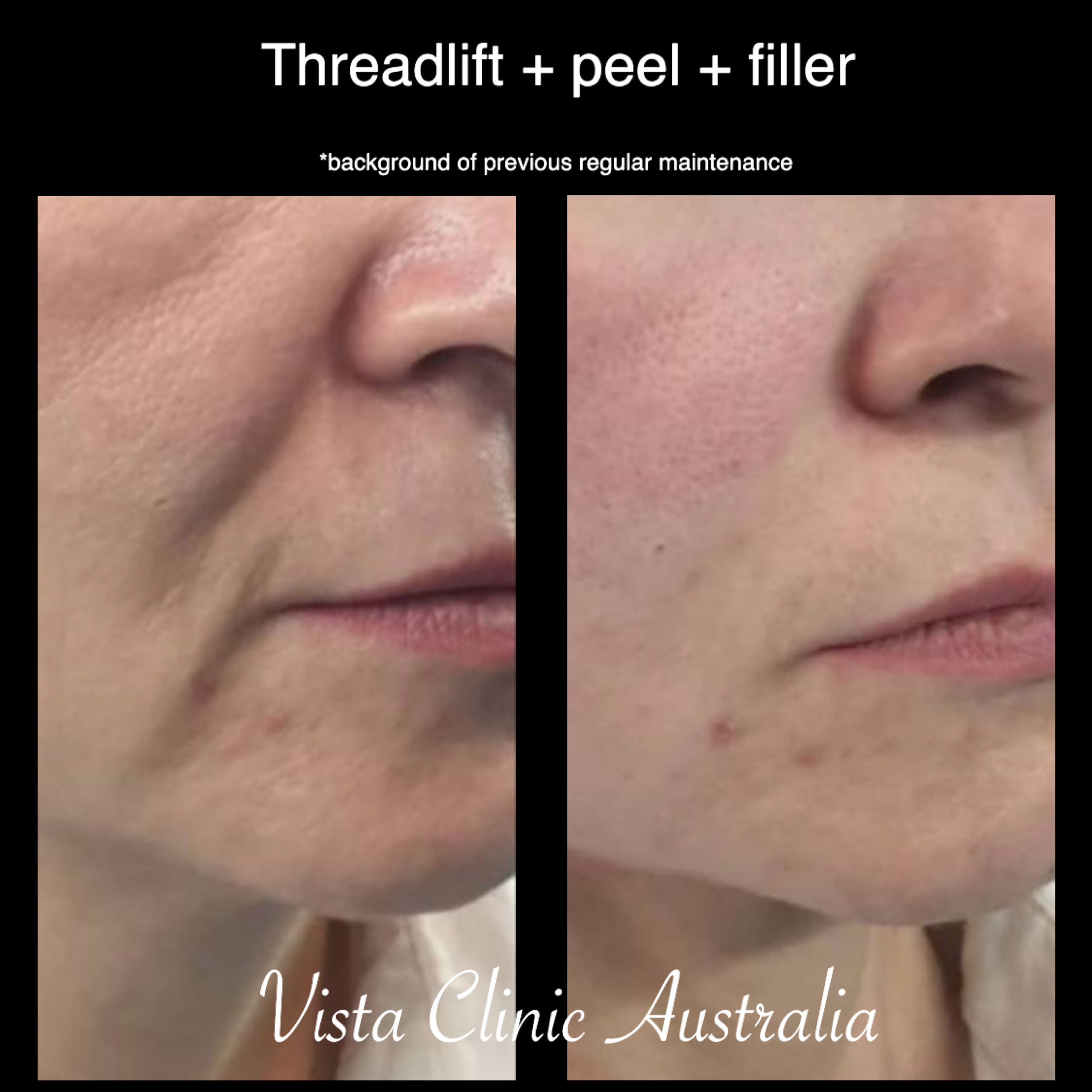 PDO thread lift Vista Clinic Melbourne Australia